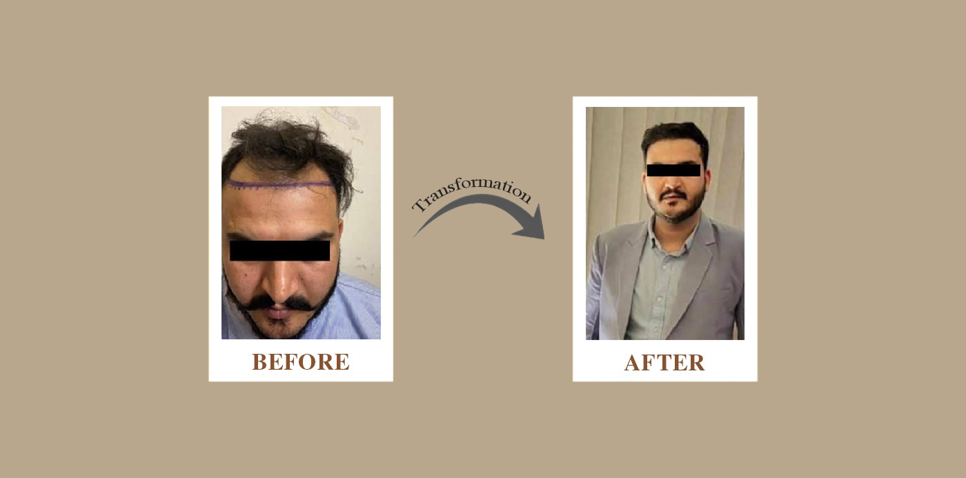 Hair Reduction